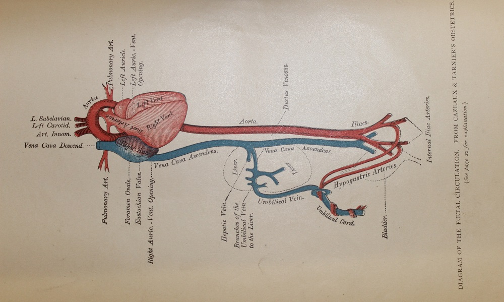Diseases of the heart and circulation in infancy and adolescence. John M Keating and William A Edwards, published Philadelphia, 1888