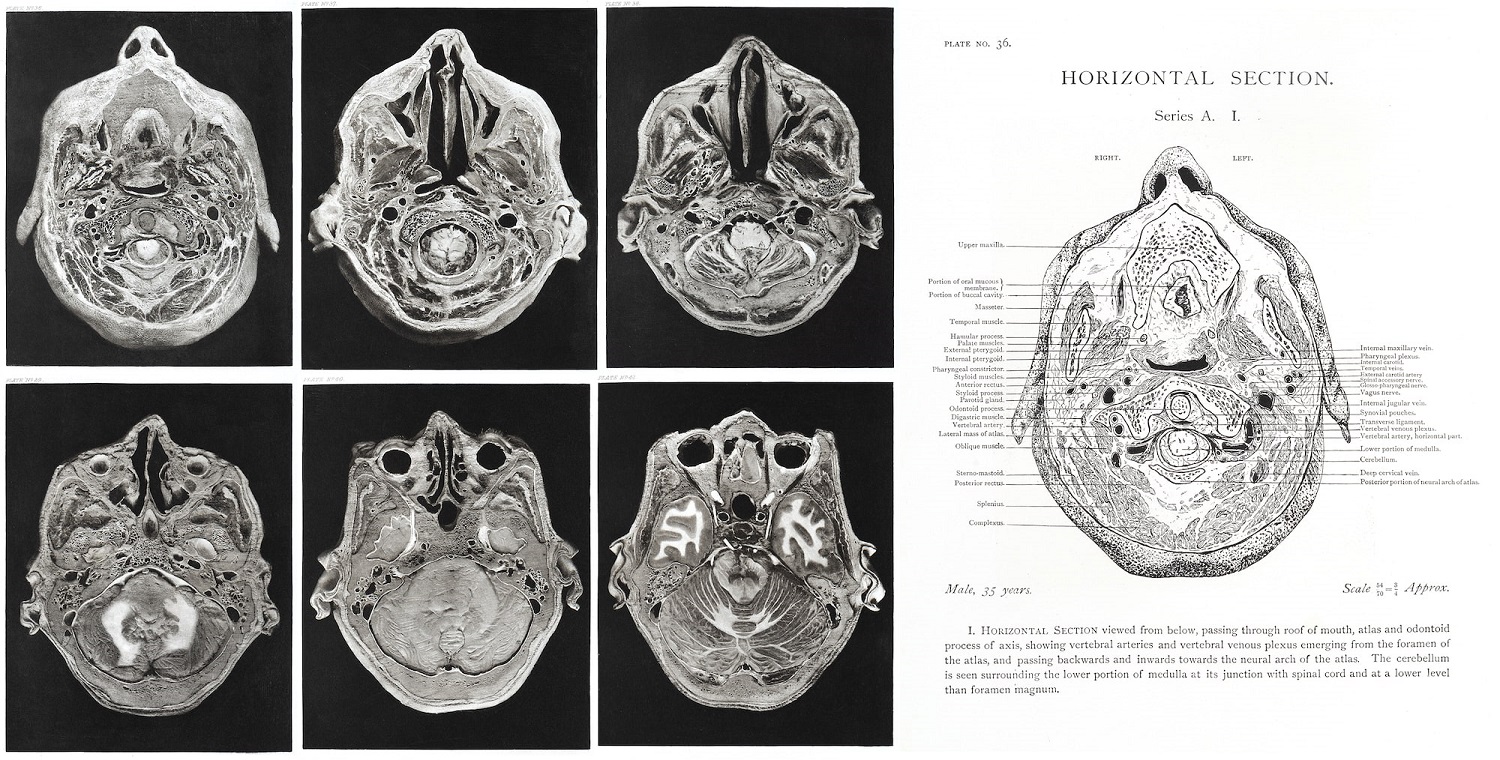 Image of six horizontal cross sections of a head and an anatomical diagram of a head.