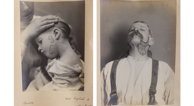 Photographs of Kate English and John Sharp in the casebook of Henry Head, c.1903.