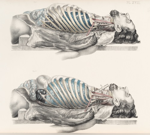 Autopsy drawing by Francis Sibson 1869