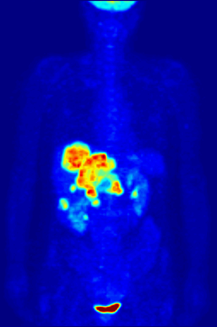 Image of PET scan of human torso