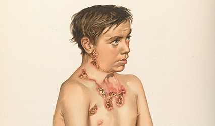 Coloured lithograph of the head and shoulders of a boy with lesions on his skin around his neck.