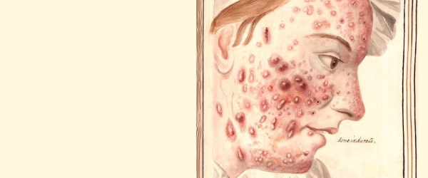 Colour drawing of woman with acne.